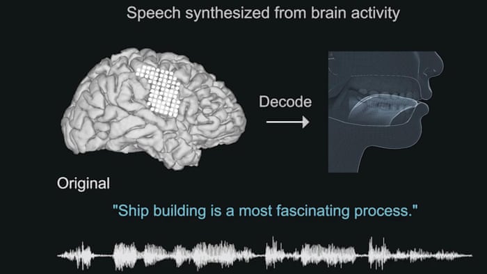 Công nghệ biến tín hiệu não thành lời nói, giúp bệnh nhân bại liệt giao tiếp - 1